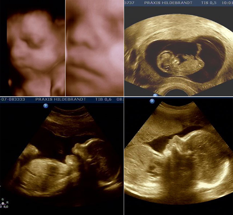 Ultraschall​ Baby
